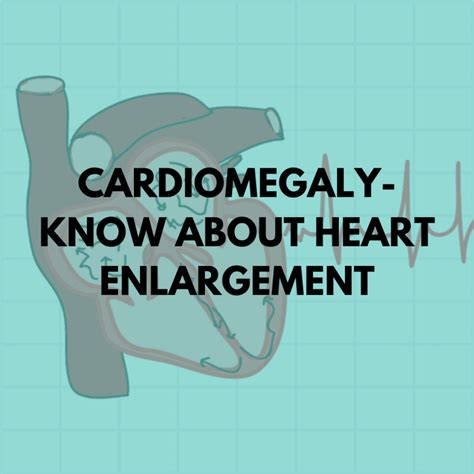 Cardiomegaly Know About Heart Enlargement Niruja Healthtech