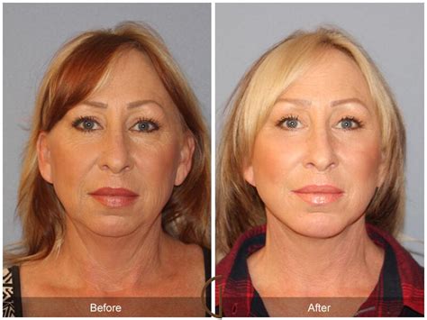 Facelift Fifties Before And After Photos Patient 41 Dr Kevin Sadati