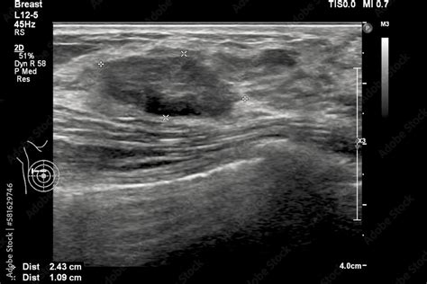 Foto Stock Image Of Breast Ultrasound For Breast Cancer Checks In Women