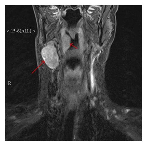 Mri Of The Neck Showing An Enlarged Lymph Node Long Arrow