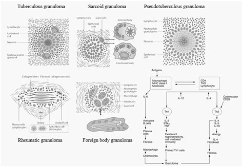 Morphology Of Granuloma Epomedicine