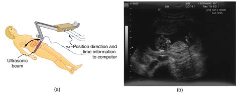 Diagram Transvaginal Ultrasound Diagram Mydiagram Online