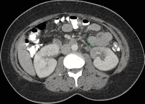 Abdominal Ct Scan With Intravenous And Oral Contrast Showing The Renal