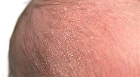 Bald spots at least at the back of the head is almost a rule for young infants, since these days we put them to sleep on their back to reduce the risk of sudden infant death syndrome. Top Home Remedies For Cradle Cap