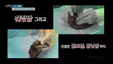 인천 구단에 따르면 유 전 감독은 이날 오후 7시께 서울 아산병원에서 사망했다. EBS 명의 스티브 잡스를 죽음에 이르게 한 췌장암, 담도암 ...