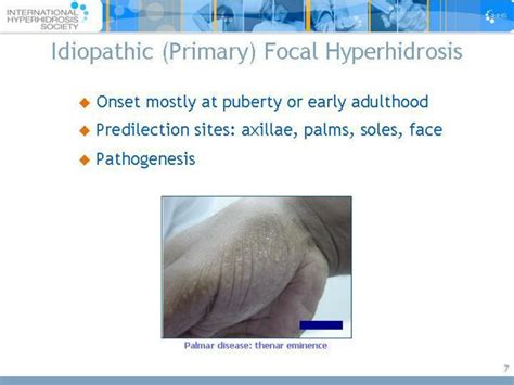 Ppt Hyperhidrosis Powerpoint Presentation Free Download Id9426301