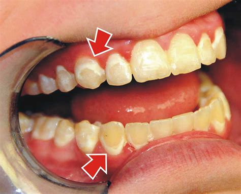 One minute it's cool to wear brand new expensive stuff, and the next you have to take all that_ and wear clothes that look as if they've been handed _ by your grandma. How Do You Treat White Spots After Braces? | Ask an ...