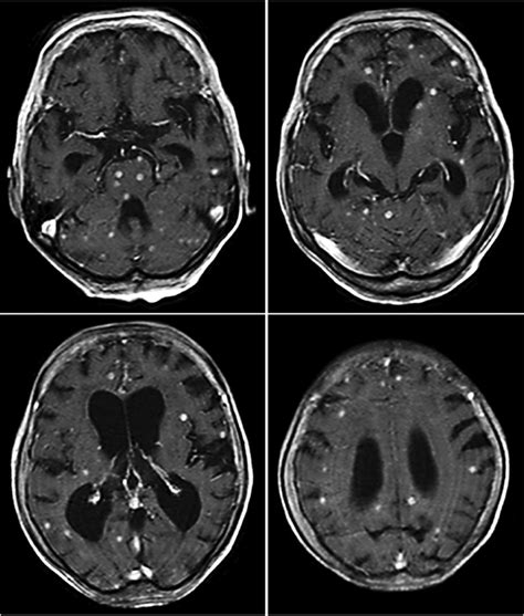 Axial View Of T1 Weighted Gadolinium Enhanced Magnetic Resonance Images