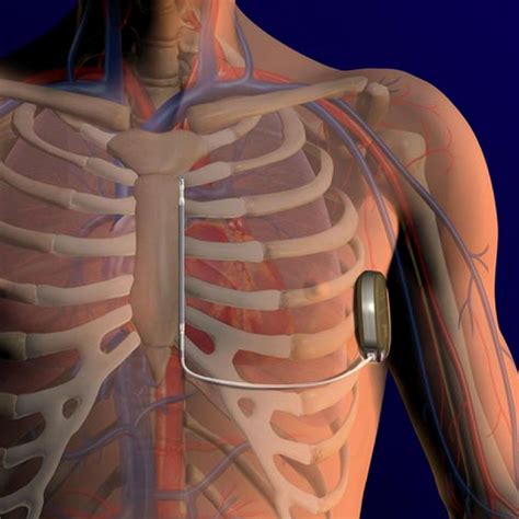 The Subcutaneous Implantable Cardioverter Defibrillator Should