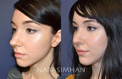 Rhinoplasty Before And After Pictures Case 97 St Petersburg Florida
