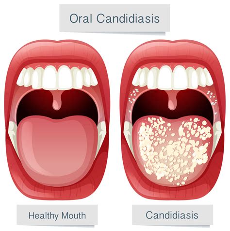 Candidiasis Oral Síntomas Formas De Contagio Y Tratamientos