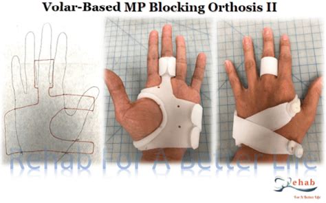 Five Common Orthosis Splint For Hand Injuries Rehab For A Better Life