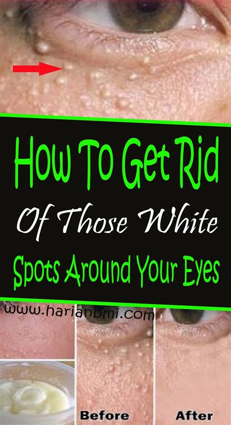 How To Get Rid Of Those White Spots Around Your Eyes How To Get Rid