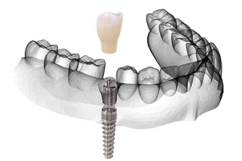 Sinus Lift Sinus Augmentation Birmingham Dental Implant Techniques