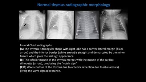 Normal Thymus Radiographic Morphology Download Scientific Diagram