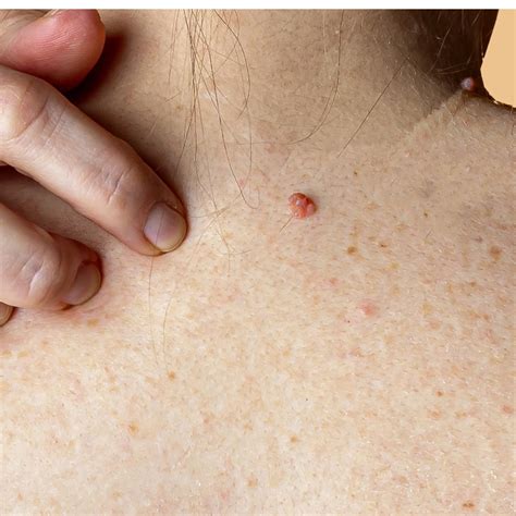 Skin Cancer Lesions Images Vrogue Co