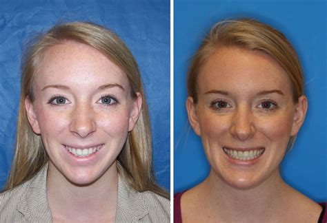 Sample Orthognathic Surgery Results Larry M Wolford Dmd