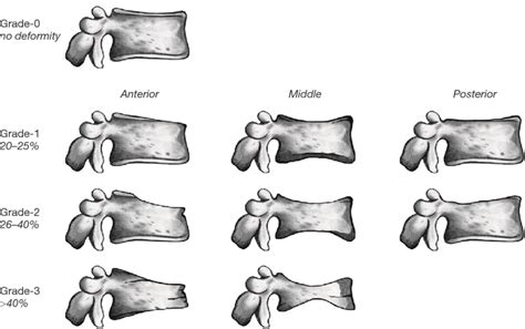 Vertebral Body Fracture Classification