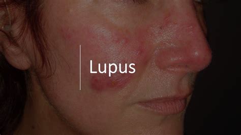 2019s Top Treatment Advances In Lupus Rheumatology Network