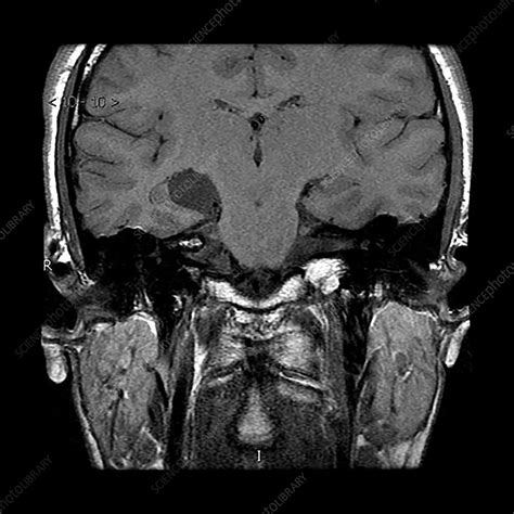 Hippocampal Choroidal Fissure Arachnoid Cyst Stock Image C0432932