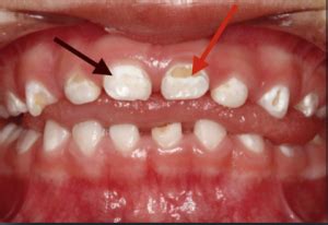 Mix a cup of hydrogen peroxide with ½ a cup of warm water, rinse your mouth for one minute, spit and then rinse again with a ½ cup of. Calcium Deposits On Teeth How To Get Rid Of - TeethWalls