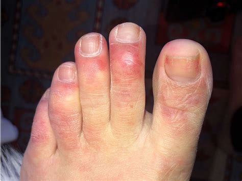 Covid Toes Blisters And Splotchy Red Skin Doctors Share The New