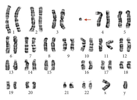 The Mosaic Karyotype Of The Patient Identified By Gtg Banding Technique Download Scientific
