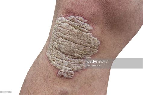 Psoriasis On A Mid Age Mans Knee High Res Stock Photo Getty Images