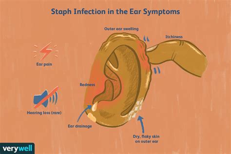 Co Powoduje Infekcje Staph W Uchu I Jak Je Leczyć Medycyna
