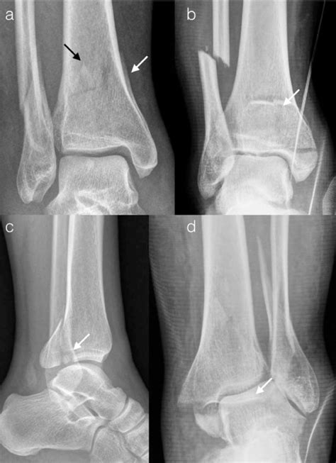 Posterior Pilon Fracture Epidemiology And Surgical Technique Injury
