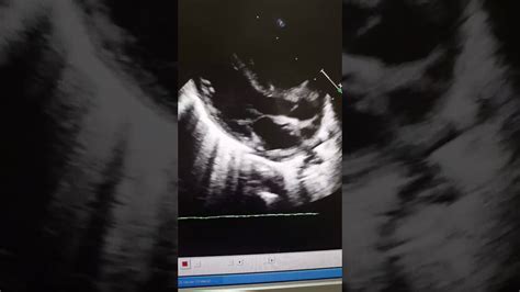 Case 23 Echocardiography Double Outlet Right Ventricular Subaortic