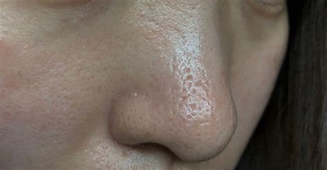 What Are Some Treatments For Deep Acne Scarring And Enlarged Pores On The Nose Photo Human