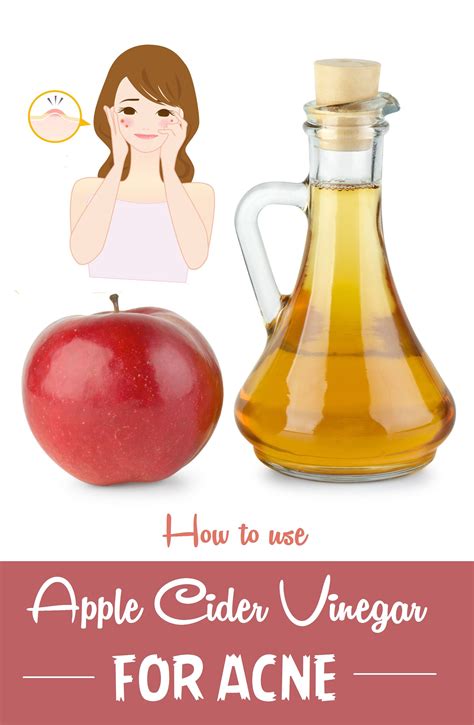 5 Surprising Benefits Of Apple Cider Vinegar For Acne Vinegar For