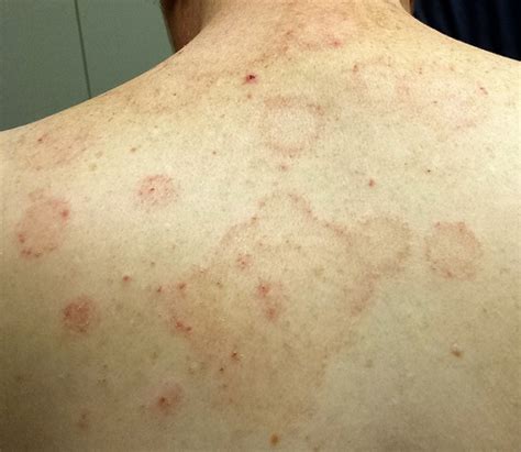 With Rashes Consider The Source Or Lack Thereof Clinician Reviews