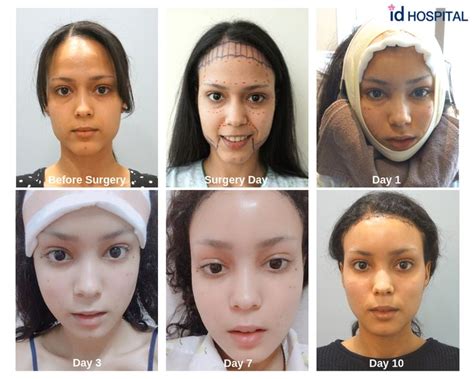 Total Transformation At Id Hospital Korea Forehead Reduction