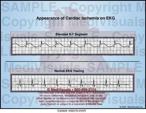 Appearance Of Cardiac Ischemia On Ekg Medical Illustration
