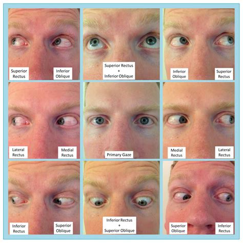 Eye Intraocular Muscle