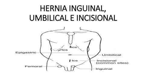 Resúmenes de Hernias inguinales Descarga apuntes de Hernias inguinales