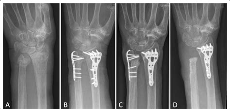 Nonunion After Ulna Plate Osteosynthesis In An Old Patient A