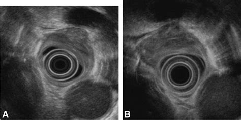 Figure 2 From Esophageal Anthracosis Complicated By Mediastinal