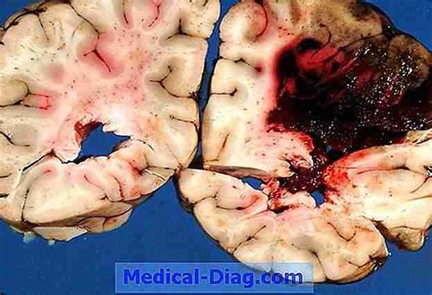 Subarachnoid H Morrhagie Risikofaktoren Bei Schwangeren Frauen Medical