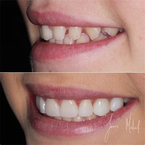 Composite Veneers Before And After Kim 3