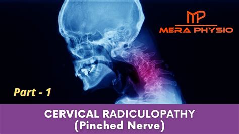 Cervical Radiculopathy Pinched Nerve Part 1 Introduction Causes
