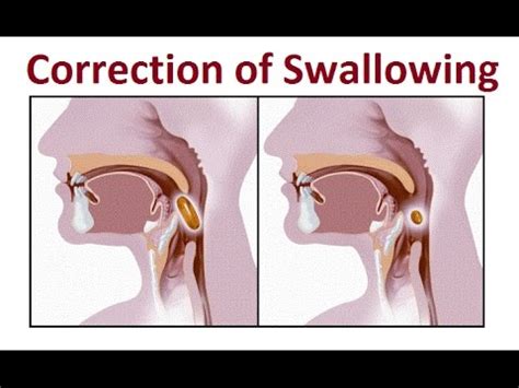 Correction Training Of Proper Swallowing Methods With Hoffman Wire By Prof John Mew Youtube