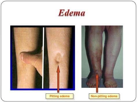 Oedema