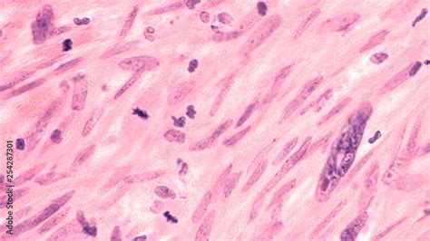 Fototapeta Microscopic Image Of A Leiomyosarcoma A Type Of Soft Tissue