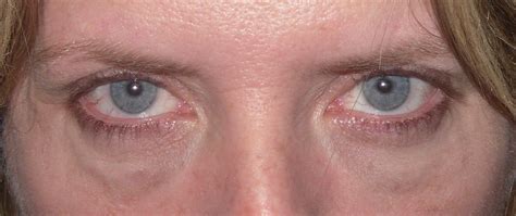 Under Eye Swelling Cream Beauty And Health