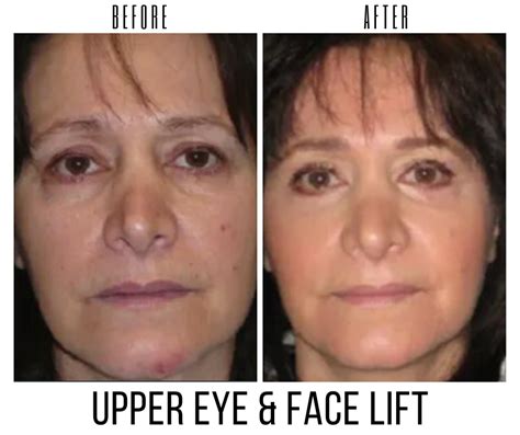 Face Lift Rejuv Spa And Cosmetic Center