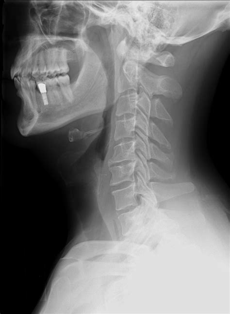 Minor symptoms include neck pain and stiffness, but numbness and more severe effects are possible. File:Cervical Xray Lateral View.jpg - Wikimedia Commons