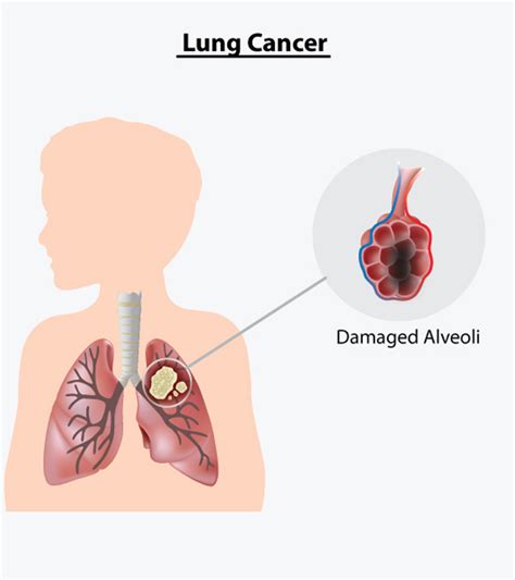 The main symptoms of lung cancer are listed below. 8 Signs And Symptoms Of Lung Cancer In Children